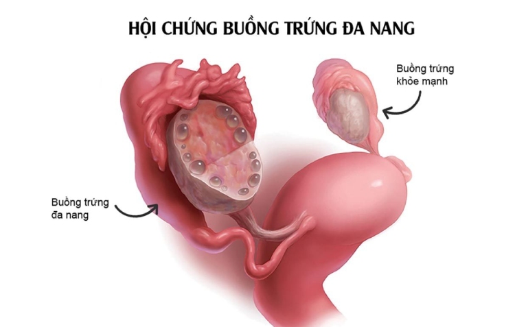 Buồng trứng đa nang gây ra sự dư thừa hormone androgen trong cơ thể - Yếu tố góp phần gây ra tình trạng thâm sạm âm đạo