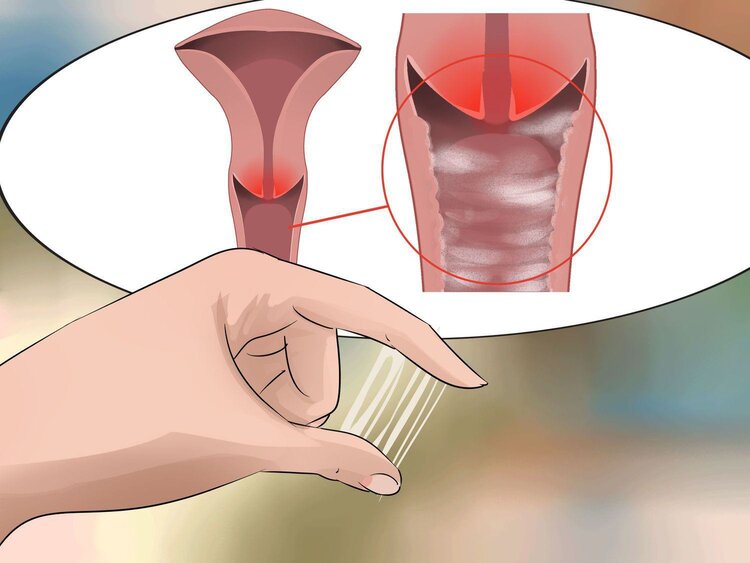 Viêm cổ tử cung nhẹ có chữa khỏi không và bằng phương pháp nào?