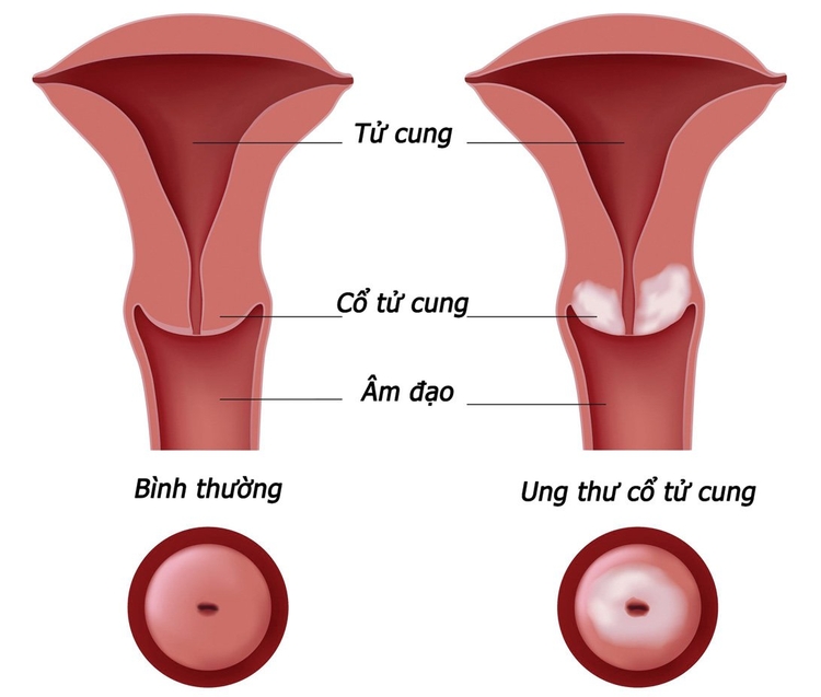 Biến chứng nguy hiểm nhất của bệnh là ung thư cổ tử cung