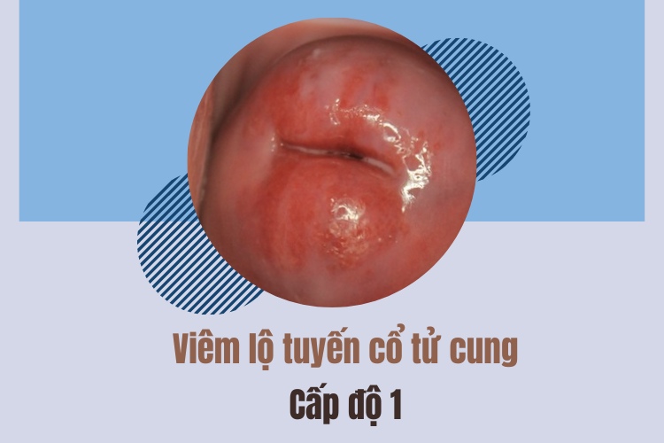Viêm lộ tuyến cổ tử cung cấp độ 1 mới chỉ hình thành tổn thương nhỏ